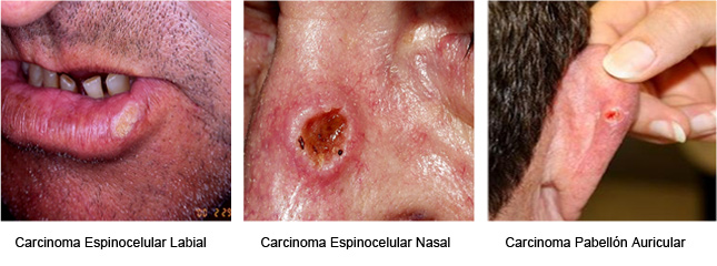 Tipos de Carcinoma Espinocelular